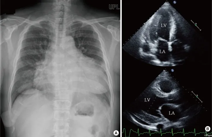 Echocardiogram: Concentric LVH in Acromegaly