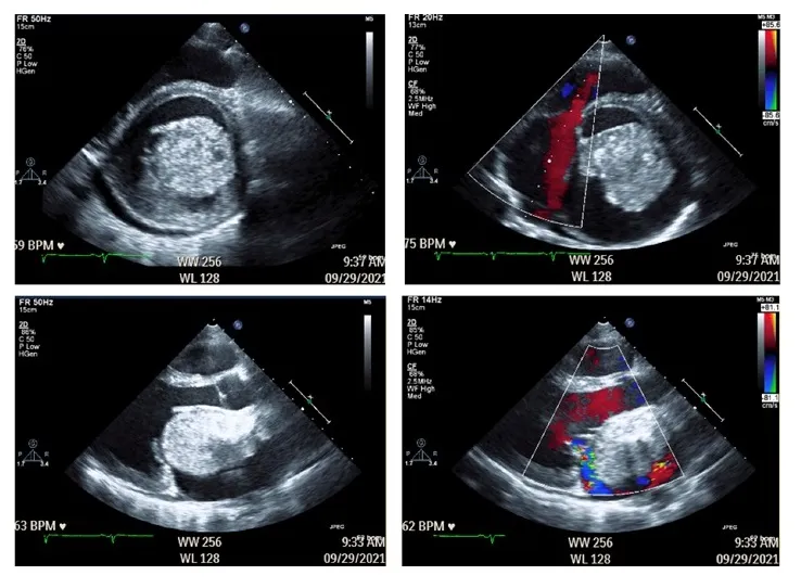 Echocardiogram: Left Atrial Myxoma Prolapsing Mitral Valve