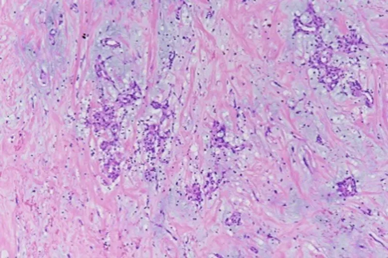 Atrial Myxoma Histology (H&E)