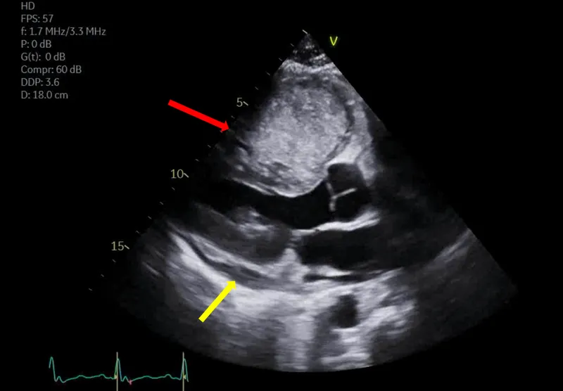Echocardiogram: Pericardial effusion & cardiac mass