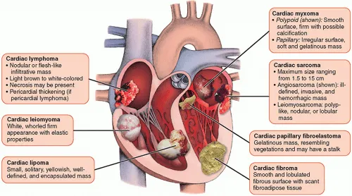 Cardiac Tumors: Location and Gross Appearance