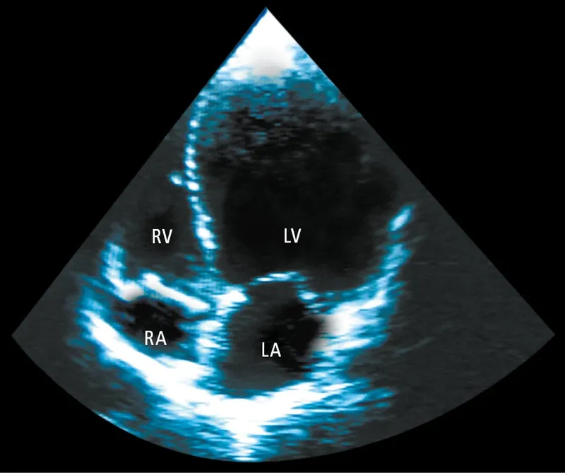 Echocardiogram of dilated left ventricle