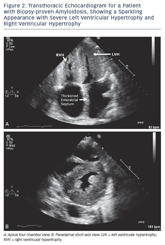Echocardiogram: Cardiac Amyloidosis with Hypertrophy