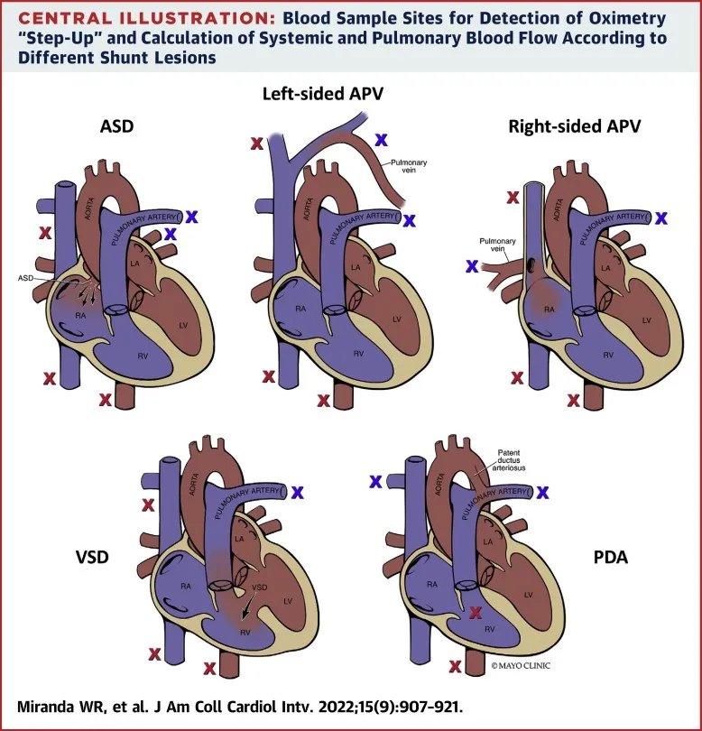 Oximetry step-up in shunt lesions