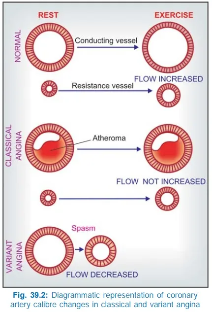 Coronary artery changes in classical and variant angina
