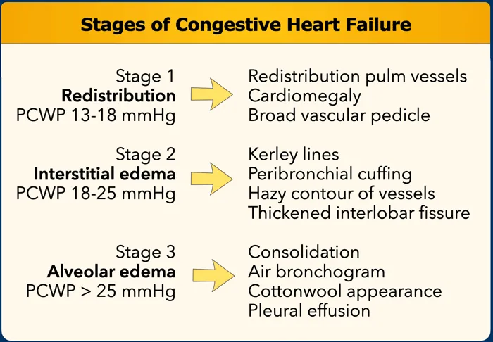 Stages of Congestive Heart Failure and CXR findings