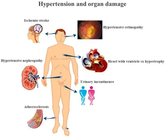 Hypertension and Organ Damage