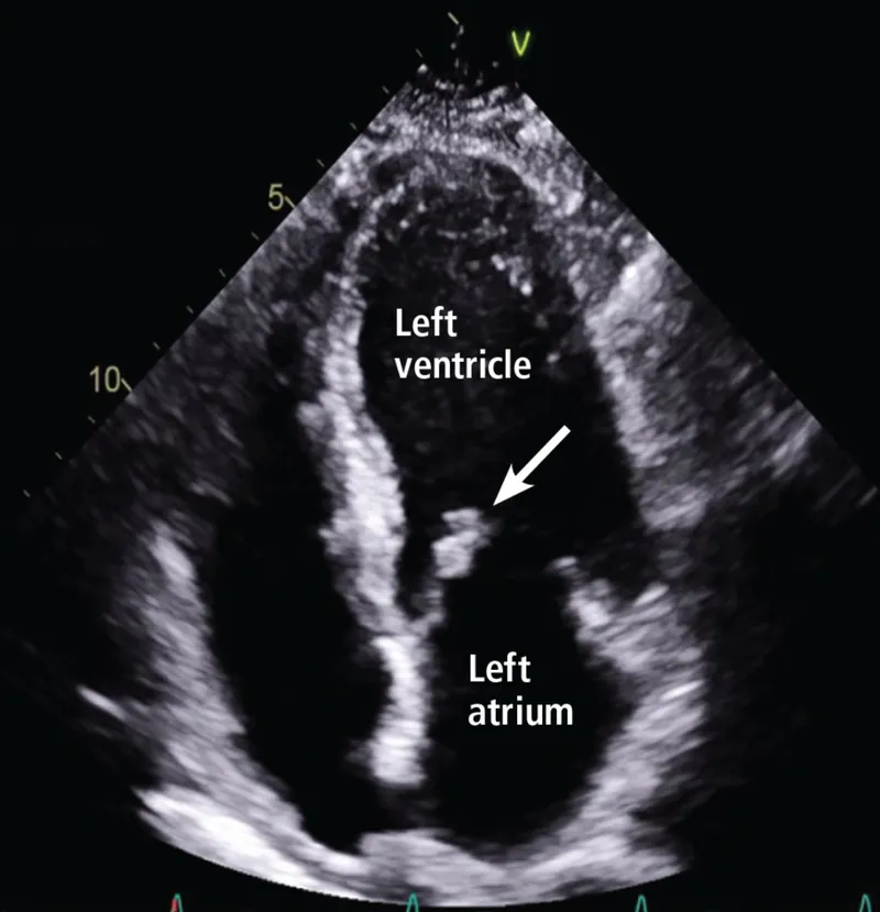 Echocardiogram showing left ventricle and atrium