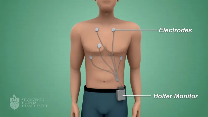 Holter Monitor Placement