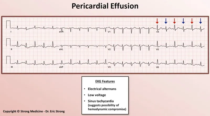ECG: Electrical Alternans in Pericardial Effusion