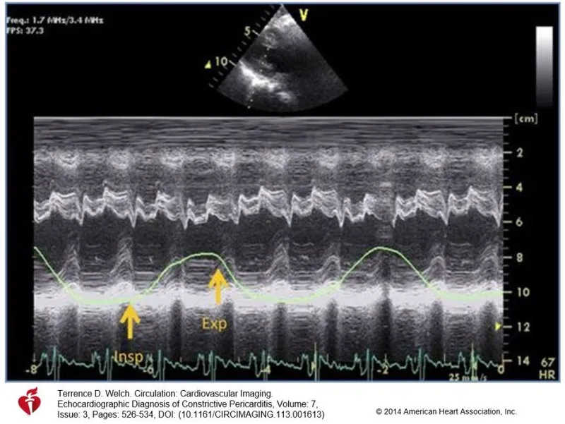 M-mode echocardiogram showing septal bounce