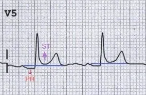 ECG: ST elevation and PR depression in pericarditis