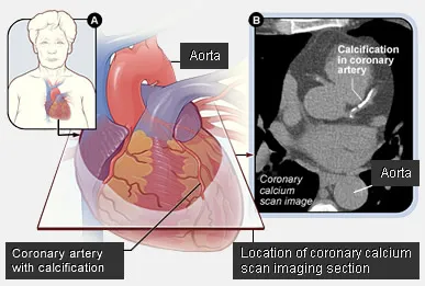 Coronary Artery Calcification: Diagram & CT Scan