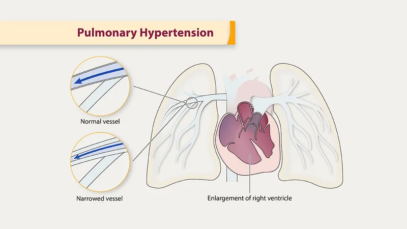 Pulmonary Hypertension: Vessel Narrowing and RV Enlargement