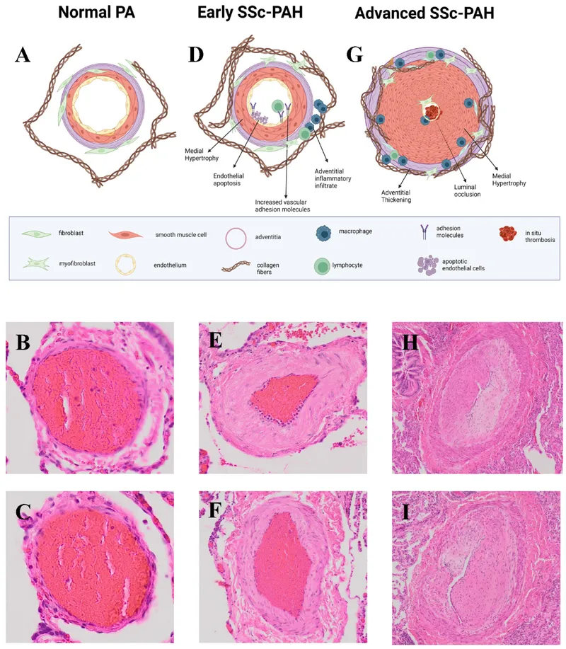 Pulmonary artery cross-section in pulmonary hypertension