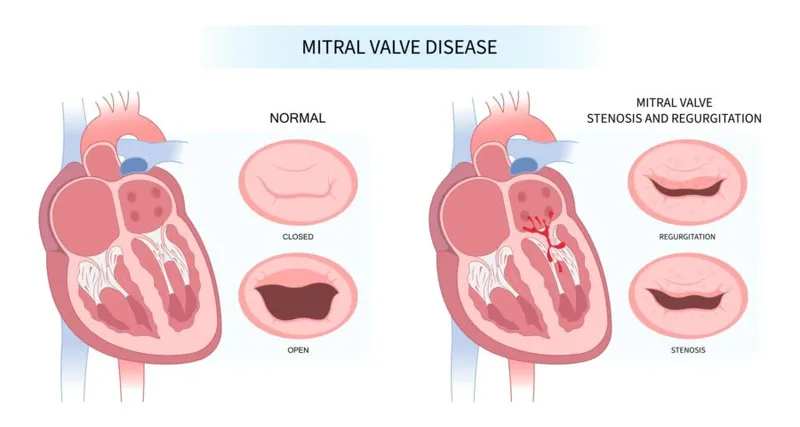 Normal vs. Diseased Heart Valves