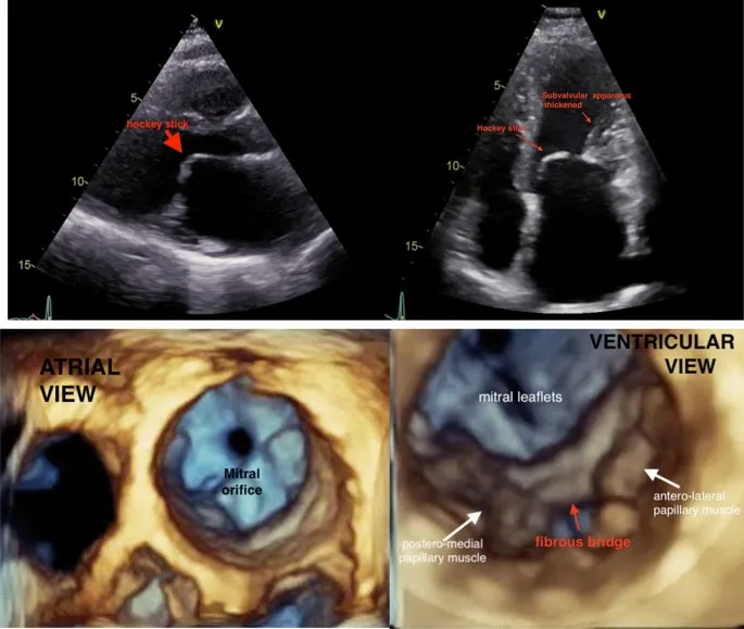Echocardiogram of mitral stenosis