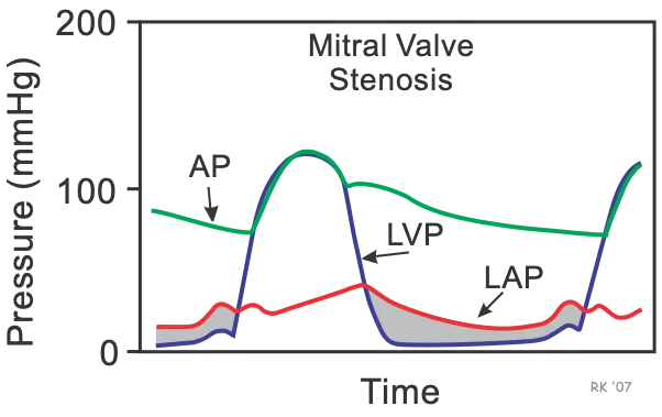 Wiggers Diagram: Mitral Valve Stenosis Pressure Changes