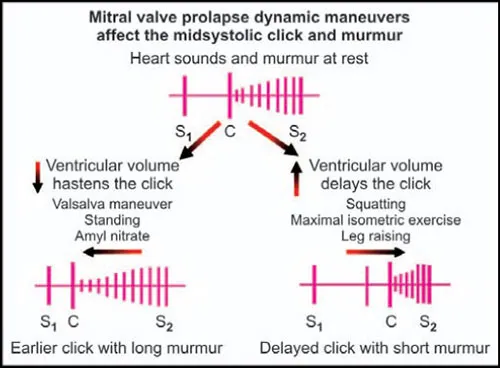 MVP murmur changes with dynamic maneuvers