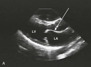 Echocardiogram: Mitral Stenosis Hockey Stick Appearance