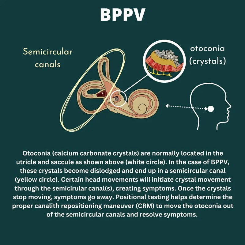 BPPV: Otoconia displacement in semicircular canals