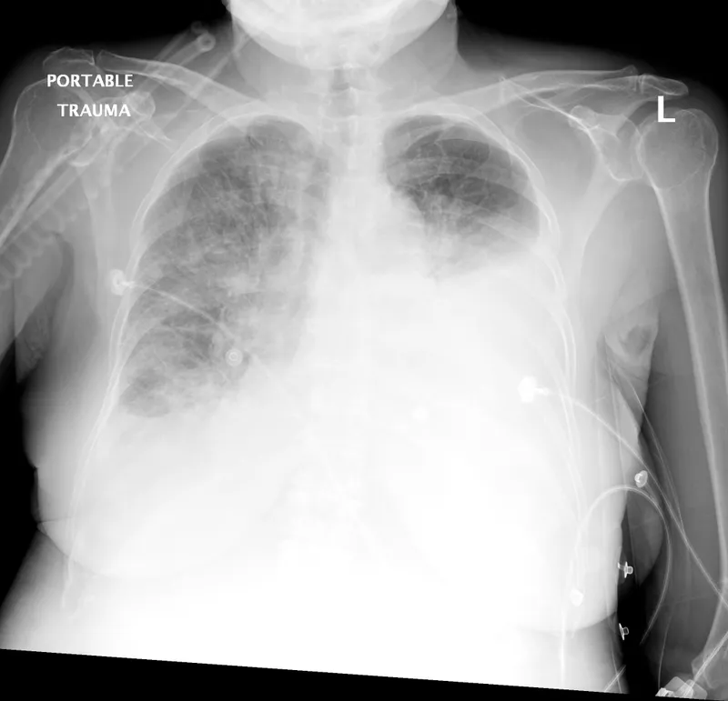 CXR showing bilateral pleural effusion and consolidation