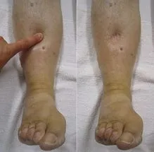 Pitting Edema Assessment