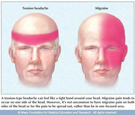 Headache pain locations