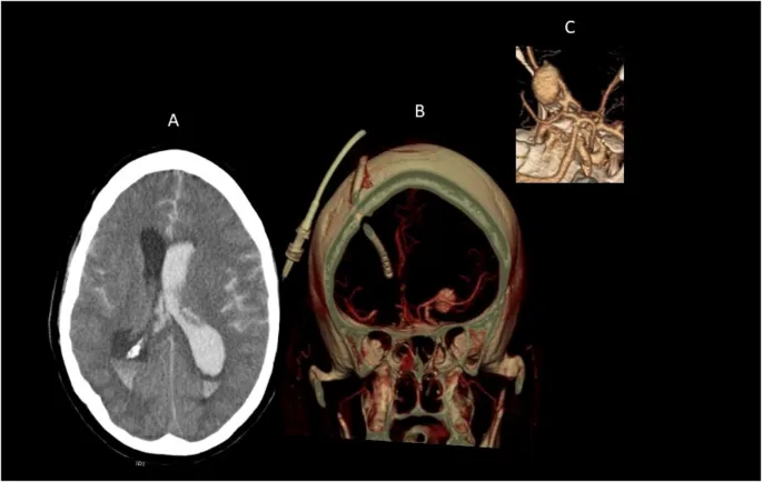 Brain hemorrhage and aneurysm