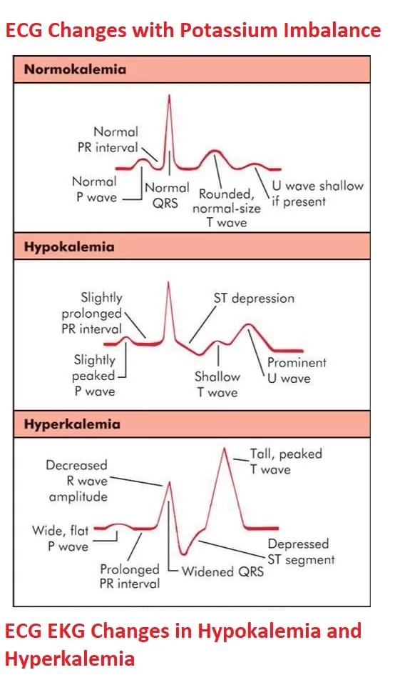 ECG changes in potassium imbalance