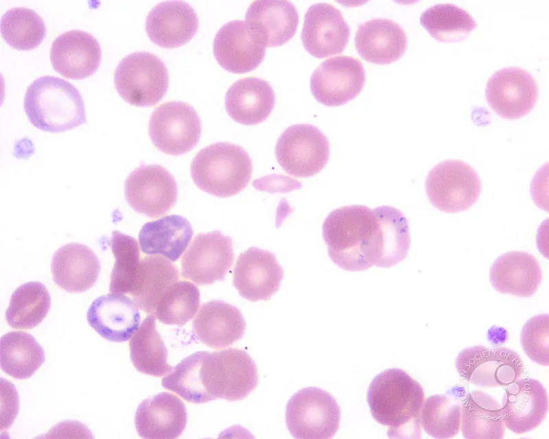 Basophilic stippling in lead poisoning peripheral smear