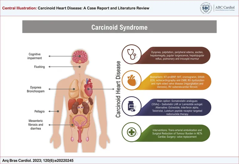 Carcinoid Syndrome: Symptoms, Heart Disease, Treatment