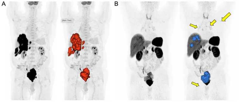 Gallium-68 DOTATATE PET CT of neuroendocrine tumors