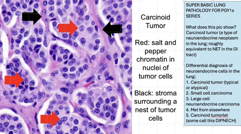 Carcinoid Tumor: Salt-and-Pepper Chromatin