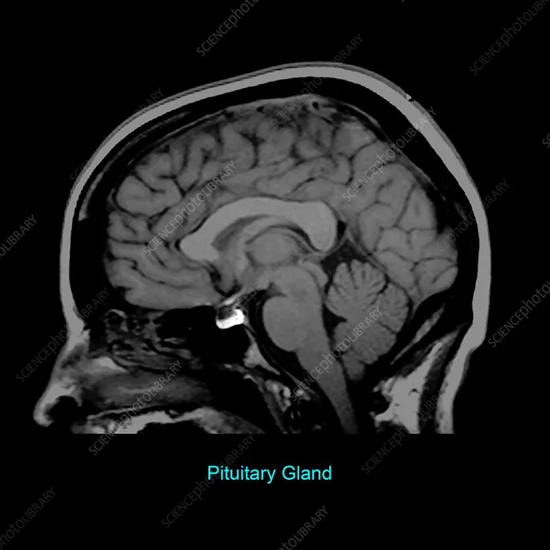 Sagittal MRI of Pituitary Gland Anatomy
