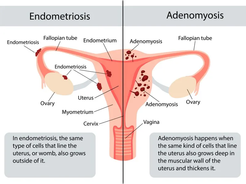 Endometriosis vs. Adenomyosis Diagram