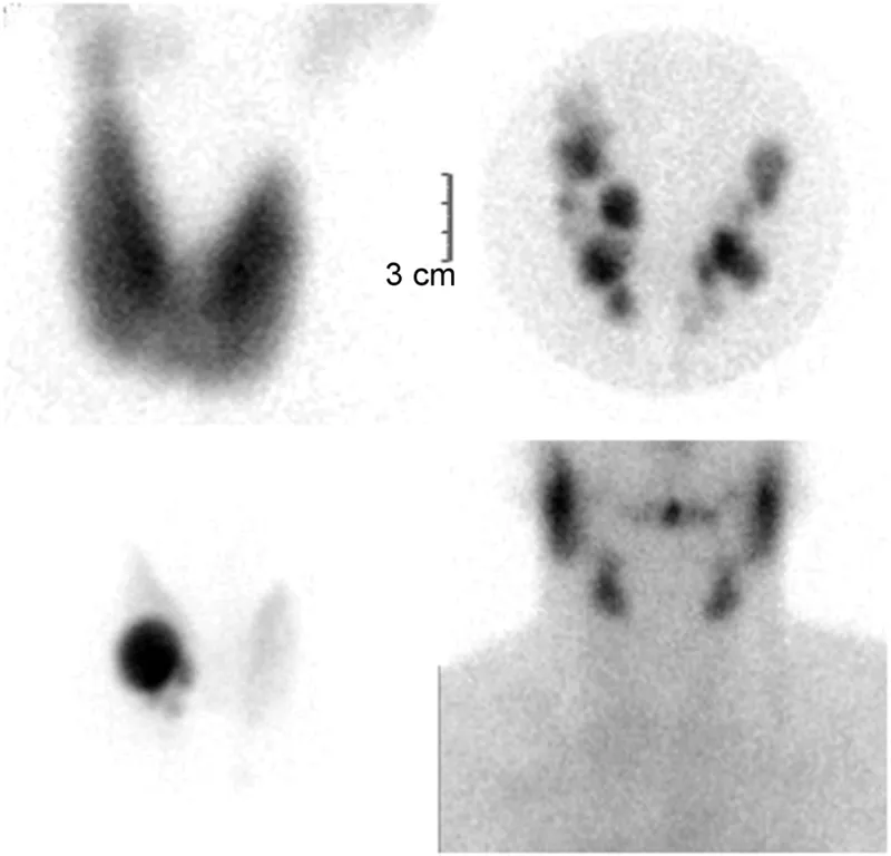 Thyroid scintigraphy: Graves disease diffuse uptake
