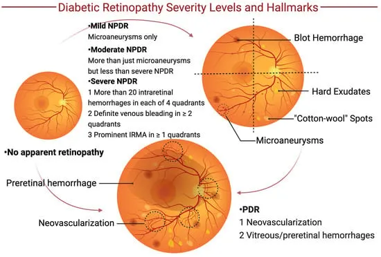 Diabetic Retinopathy Severity Levels and Hallmarks