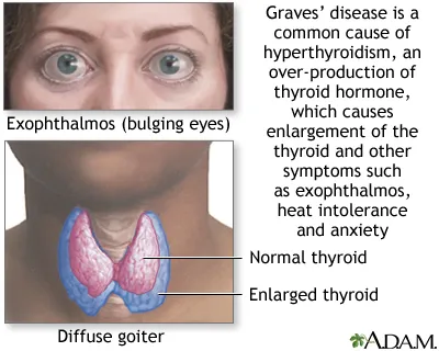 Graves' disease: exophthalmos and goiter