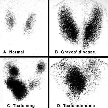 Thyroid scans: Normal, Graves', Toxic MNG, Toxic Adenoma