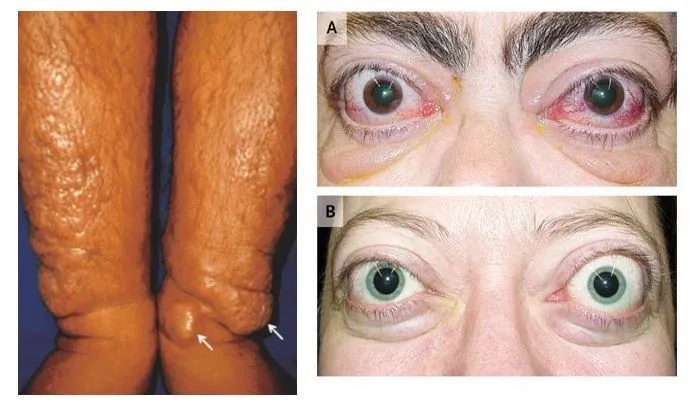 Graves’ ophthalmopathy and pretibial myxedema