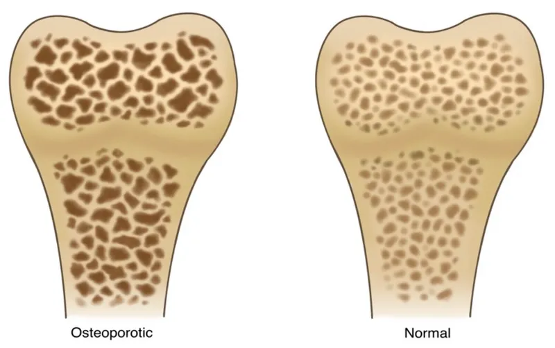 Osteoporotic vs. Normal Bone Microstructure