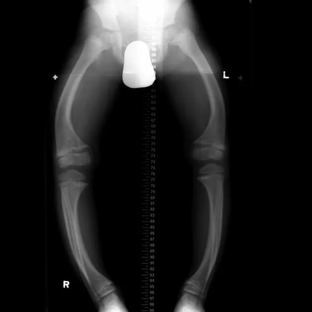 X-ray of lower limbs showing bowing deformity in rickets