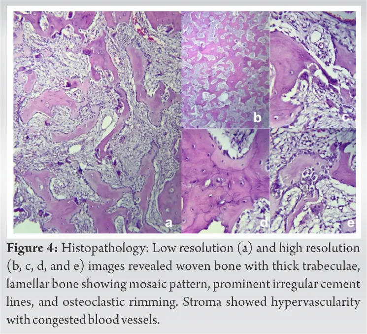 Histopathology of Paget disease: mosaic bone pattern