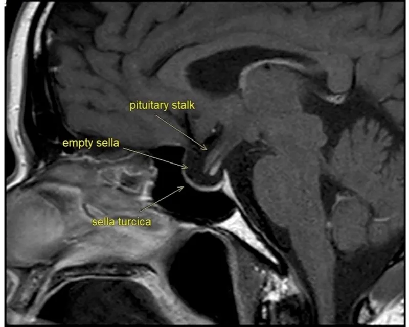 Sagittal MRI: Empty Sella Turcica