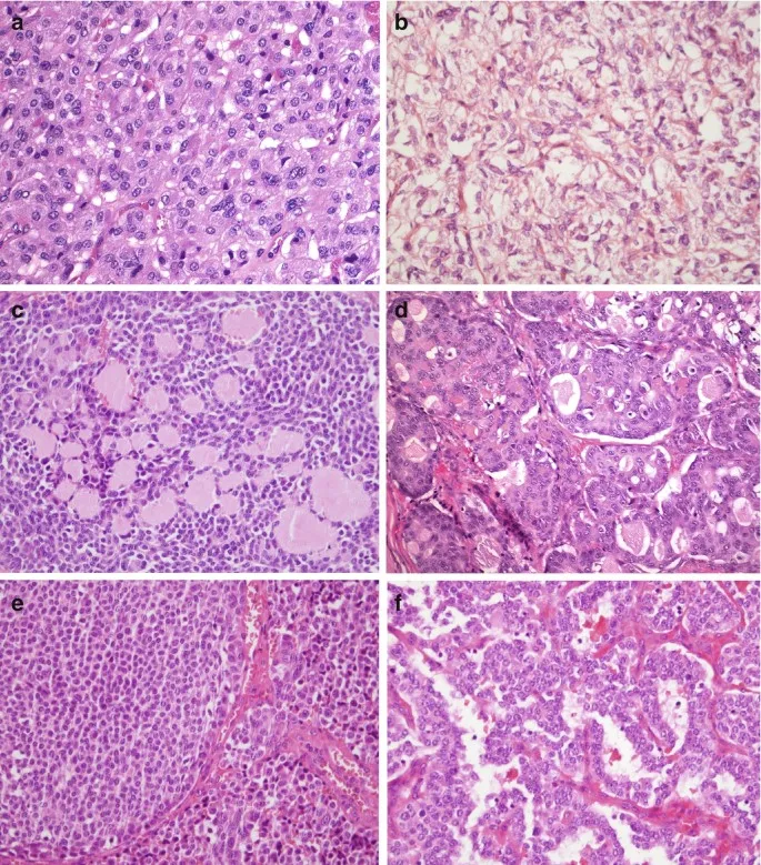 Thyroid Cancer Histology Composite
