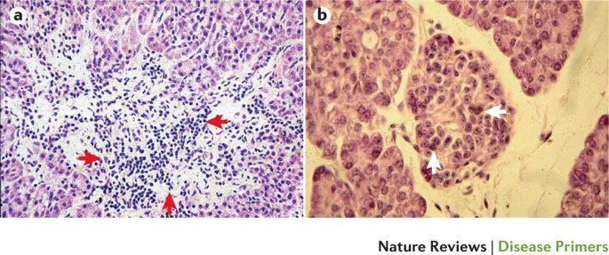 Pancreatic islet histology: insulitis vs. normal islet