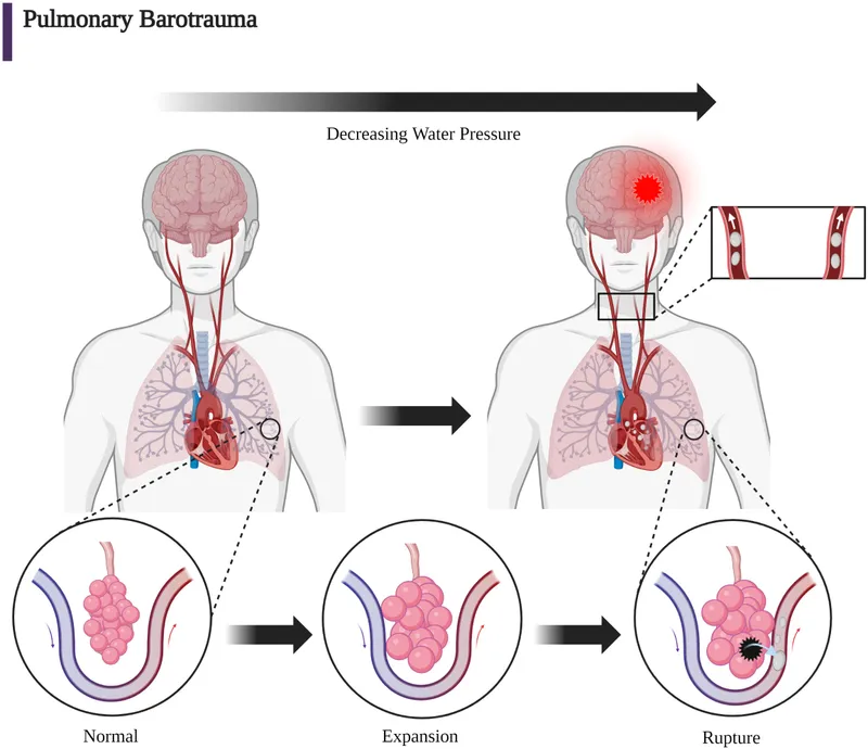 Pulmonary Barotrauma Mechanism