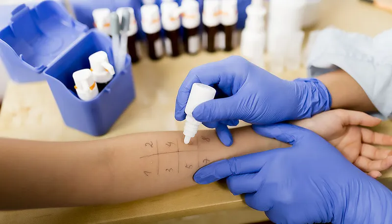 Allergen skin prick test on patient arm