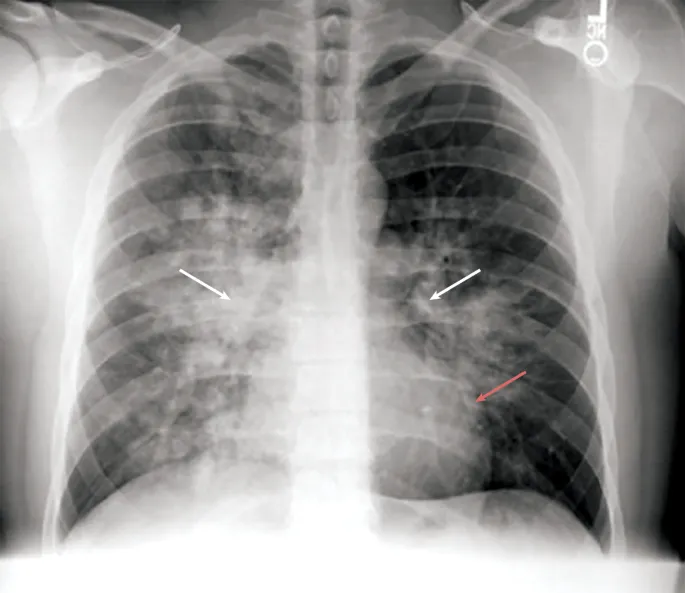 CXR showing bilateral patchy infiltrates in HAPE